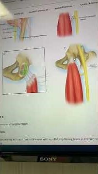 Proximal Hamstring Repair - rehab journey begins