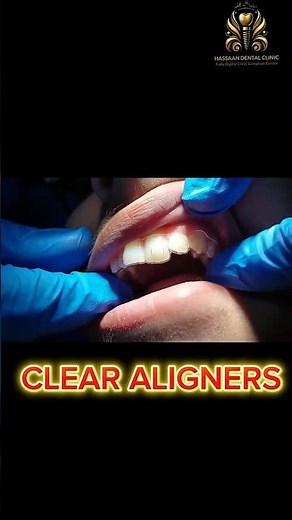 Miracle Aligners That Apply In Seconds