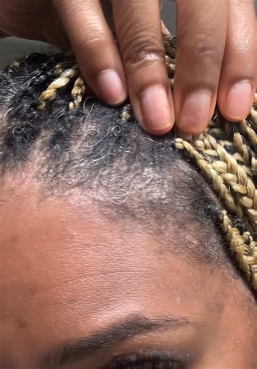 Alil Bit of Scratching for Seborrheic Dermatitis