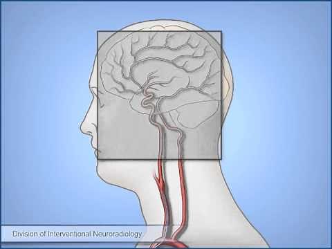 Diagnostic Cerebral Angiography