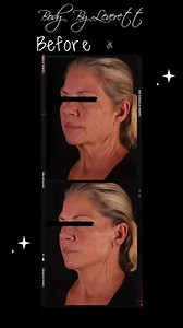 PDO ThreadLift Before & After Results