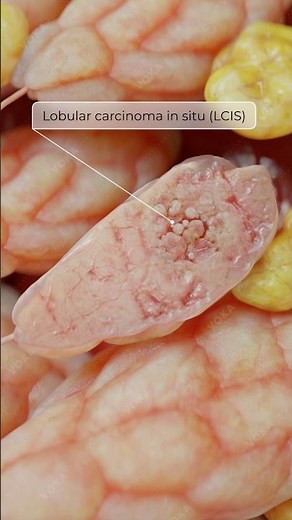 Lobular Carcinoma In Situ (LCIS): Understanding Breast Pathology | 3D Medical Animation