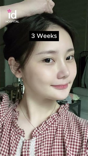 Facial Contouring Surgery transformation in Korea #idhospital #shorts