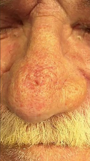 Popping Nose Blackheads | Dr. Derm