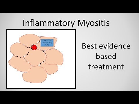 Myositis (Inflammatory Myopathy) Treatment