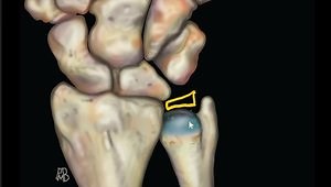 [Wrist MRI] Triangular Fibrocartilage: Cartilage Anatomy