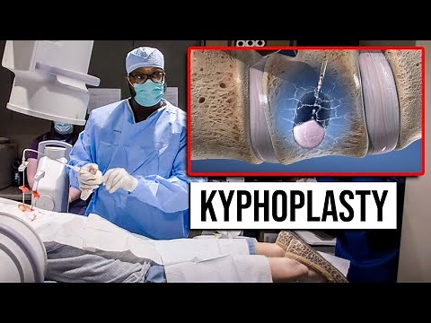 Kyphoplasty | Outpatient - Same Day Procedure for Vertebral Compression Fractures