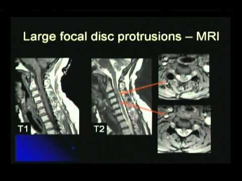 Disc Protrusion