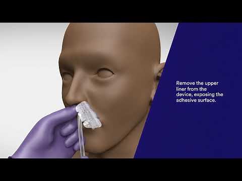 3M™ Nasogastric Securement Device Application and Removal Video