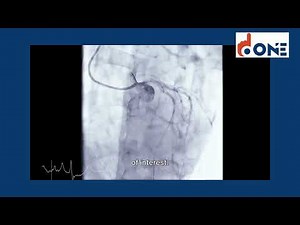How Angiogram Done?, Explained | One Cardiac Centre | Chandanagar, Hyderabad