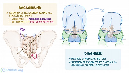 Sacral Torsion: What Is It, Causes, Treatment, and More | Osmosis