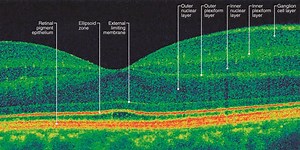 What Is Optical Coherence Tomography?