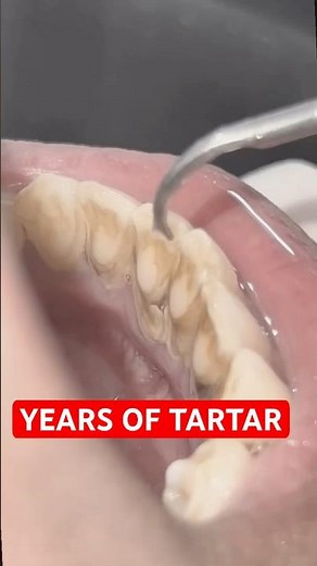 Dental Cleaning ASMR | Instant Tartar Removal