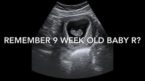 28 reactions · 4 comments | First Glimpse Ultrasound on Reels | Facebook