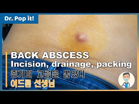 Large Back Abscess. Incision, drainage, and packing | Dr. Pop It!