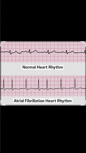 🔶️A normal ECG & Atrial fibrillation 🔶️