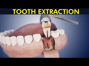 Tooth Extraction: Having a tooth pulled out Procedure