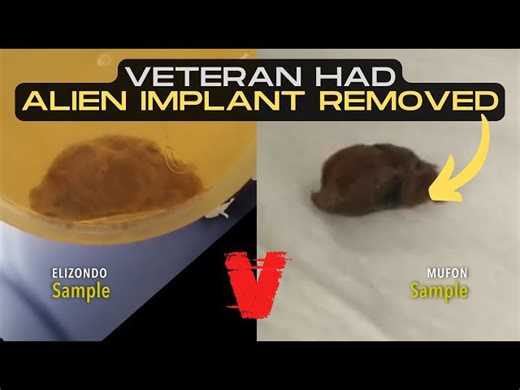Alien Implant removed from Veteran - exclusive interview