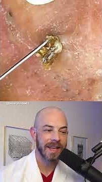 Derm reacts to massive blackhead removal! #dermreacts #doctorreacts #blackheadextraction