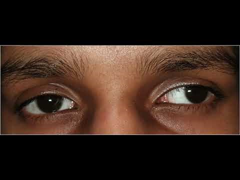 Hirschberg ReflexTest