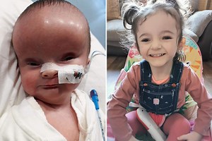 Our baby was born looking like Space Raider alien after her brain swelled