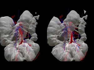 HoloeyesXR/Eduで学ぶ3D外科手術⑦結腸左半切除術: CT画像/手の動き/音声解説