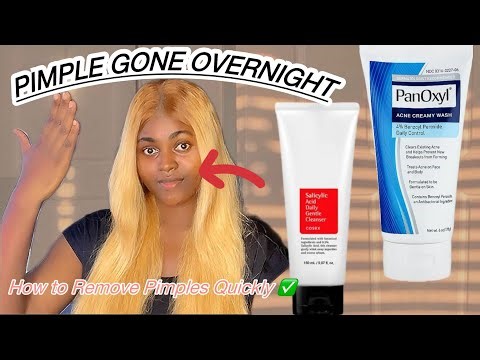 How To Get Rid of Pimples Fast | Clear Skin Overnight | Fast Acne Treatment That Works