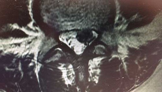 Lumbar Disk Disease (Herniated Disk)