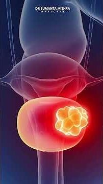 Urinary Bladder Cancer: Early Symptoms, Causes & Best Treatment