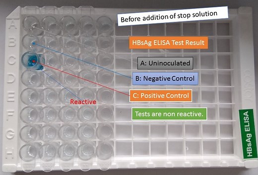 HBsAg ELISA: Introduction, Principle, Procedure, Result Interpretation