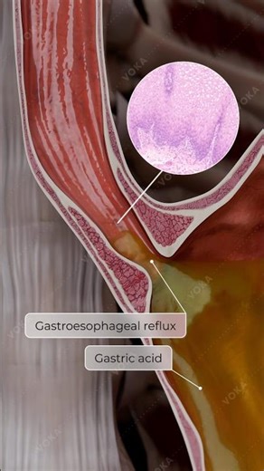 Barrett’s Esophagus: The Hidden Risk of Chronic GERD | 3D Animation Explained