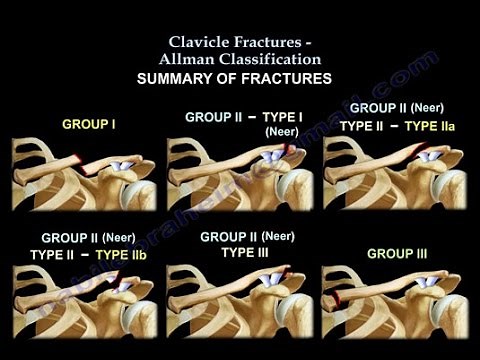 Clavicle Fractures Classification - Everything You Need To Know - Dr. Nabil Ebraheim