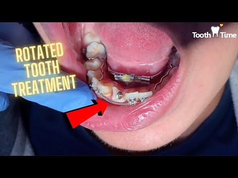 Rotated tooth treatment - braces checkups - Tooth Time Family Dentistry