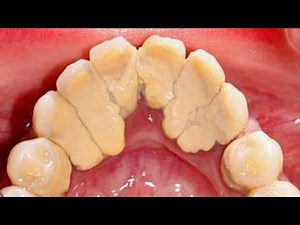 Heavy Calculus Tartar Removal 大規模な歯石の洗浄-歯石の除去 🦷 [Remove Hidden Teeth Tartar] #09 DentalCare