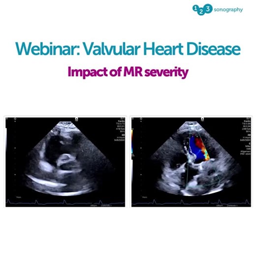 123sonography on Instagram: "Watch this extract from our webinar on aortic valve disease! 🧐 👀 Moderate AS differs from Severe AS in many ways, with distinct differences often visible using qualitative and semi-quantitative methods. However, we need to ask ourselves: how benign is Moderate AS – especially compared to Severe AS? The 2025 Valvular Heart Disease Guidelines mark a significant shift in how we view this risk. At the end of the extract, you will see a diagram from a 2019 study. Which 