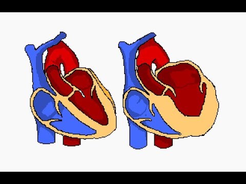 Left Atrium Hypertrophy or left atrial enlargement LAE