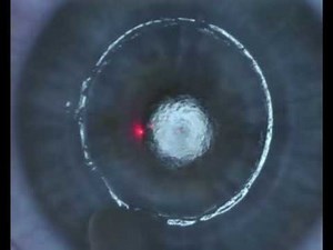 Perfect PRK / Advanced Surface Procedure by Professor Dan Reinstein