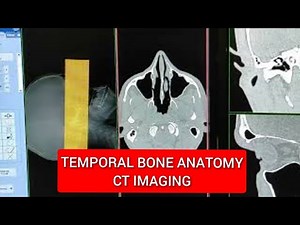 Temporal Bones Anatomy.