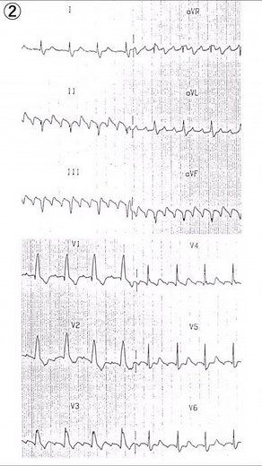 【1min ECG】通常型心房粗動をひたすらみる！ #shorts