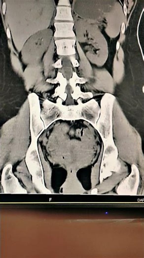 CT Pyelogram (Coronal View) #anatomy #lifeisbutadream #coronal #contemporaryart