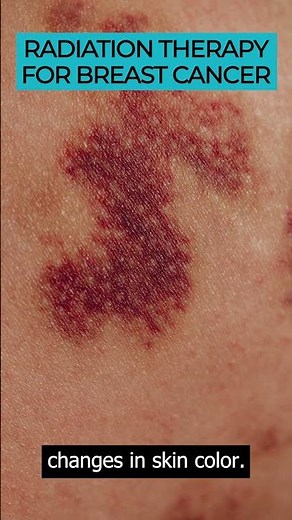 Discover the benefits and risks of radiation therapy for breast cancer patients 🎗️💡