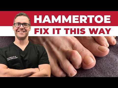 How to Fix Hammer Toes at Home [Overlapping & Crossover Toes]!