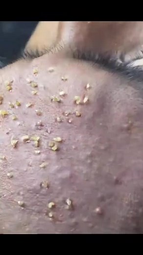 Video relanxante pour s'endormir (point noirs, acné, bouton)