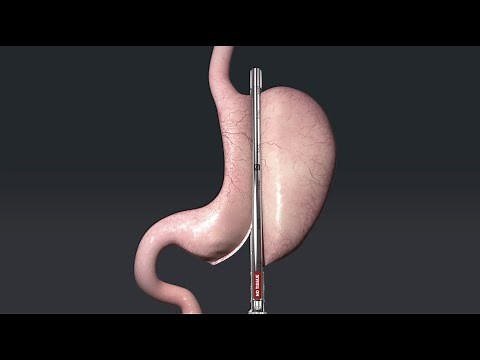 Animation of Sleeve Gastrectomy with Titan SGS™