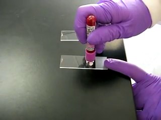 Blood Smear in Microscopy - Process/Technique, Artifacts/Refractiles