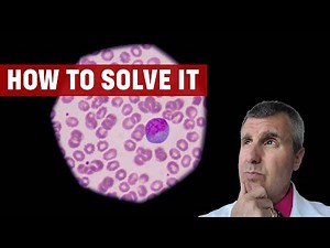 All About Lymphocytic Colitis