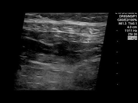 Ultrasound-guided TAP block