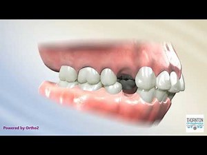 4 First Premolar Extraction for Bimaxillary Protrusion
