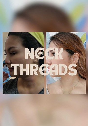 Achieve a Firmer Neck with Neck Threads Treatment
