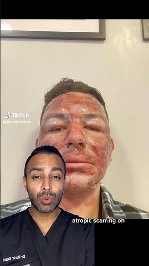 Is Getting An Extreme Chemical Peel Worth It? Dr Somji Explains